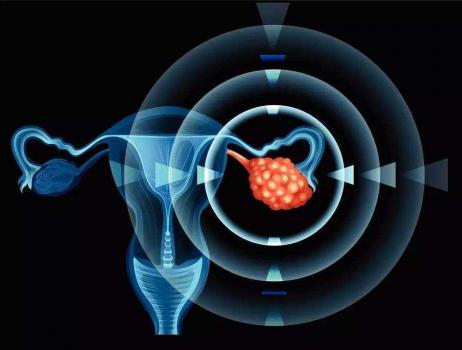 女性到底该不该筛查卵巢癌